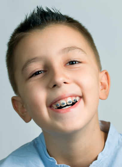 Types of braces
